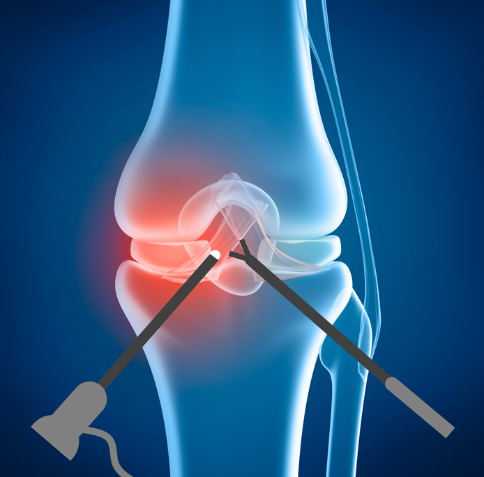 Knee problem, x-ray view
